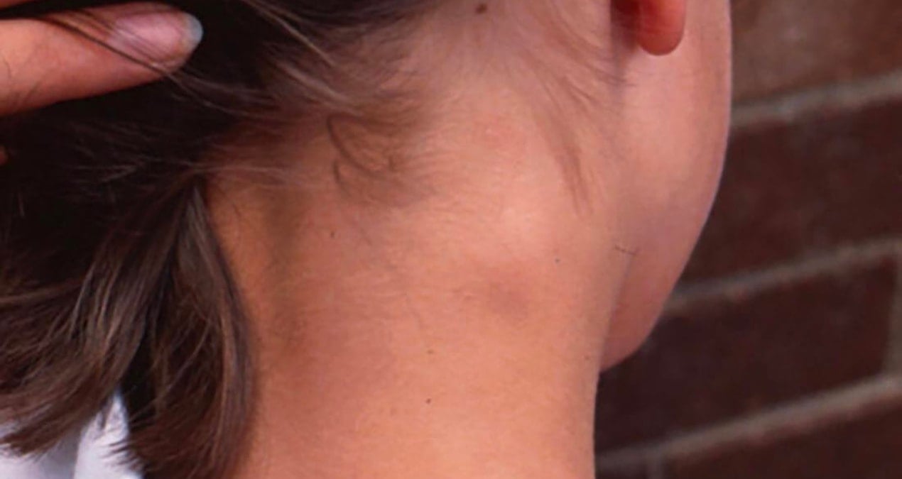 boyunda olusan sislikler ciddi hastalik belirtisi olabilir fvrxI7A5