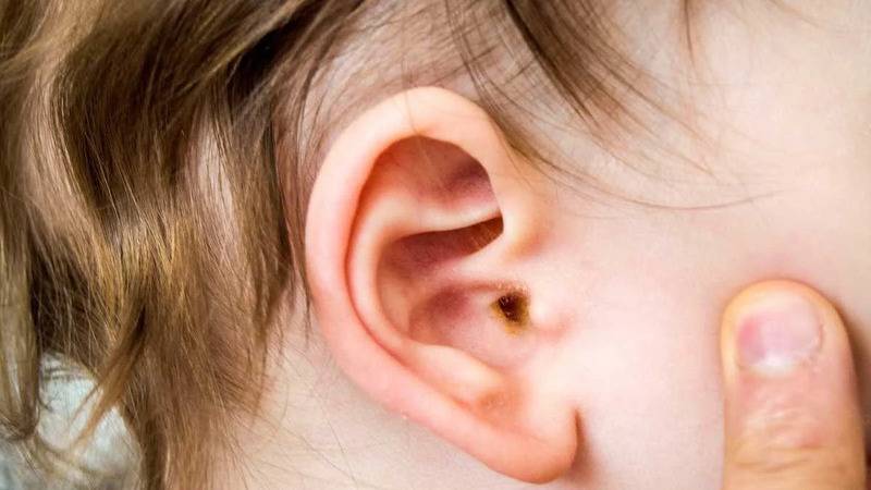 uzmani uyardi orta kulak iltihabi cocuklarda gecici isitme kaybina neden olabilir 4HteOBQB